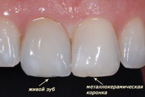 Протезирование зубов металлокерамикой.Стоматологический туризм